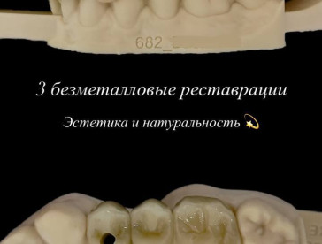Мост на имплантате. Имплант + мостик — комфорт, надёжность и натуральный вид.